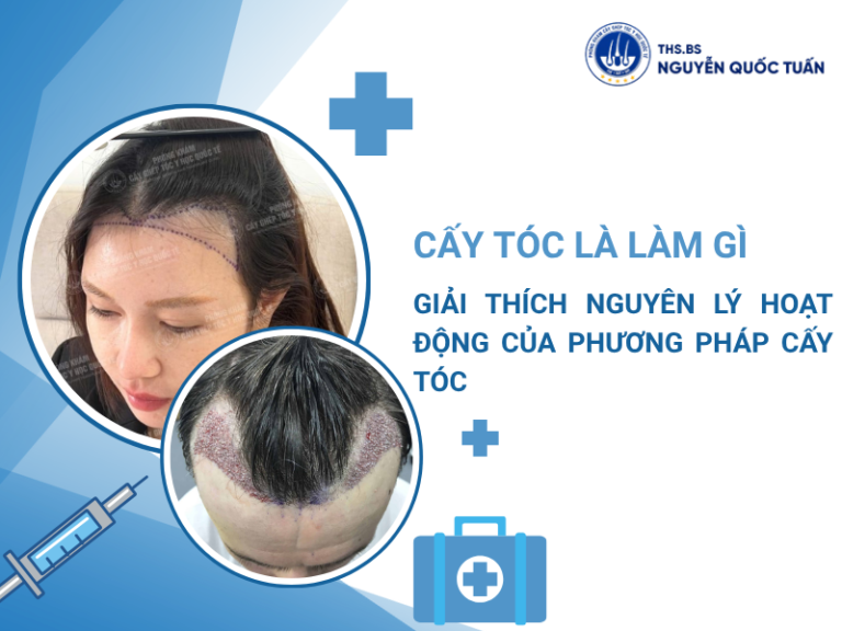 cấy tóc là làm gì