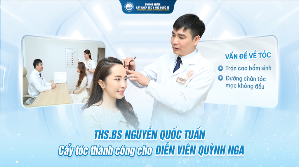 THS.BS Nguyễn Quốc Tuấn cấy tóc thành công cho Diễn viên Quỳnh Nga