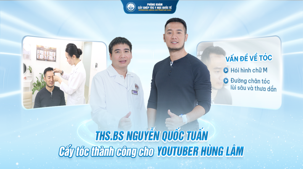 THS.BS Nguyễn Quốc Tuấn cấy tóc thành công cho Youtuber Hùng Lâm