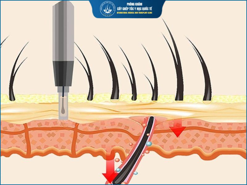cấy tóc fue là gì 
