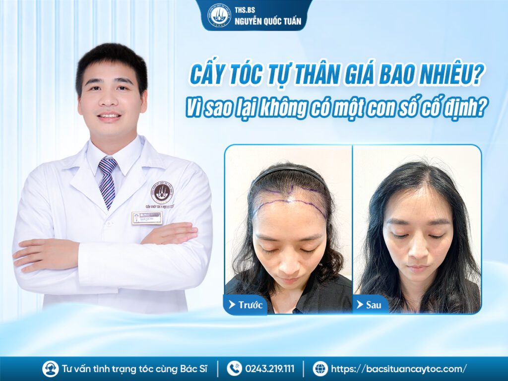 Cấy tóc tự thân giá bao nhiêu? Vì sao không có một con số cố định