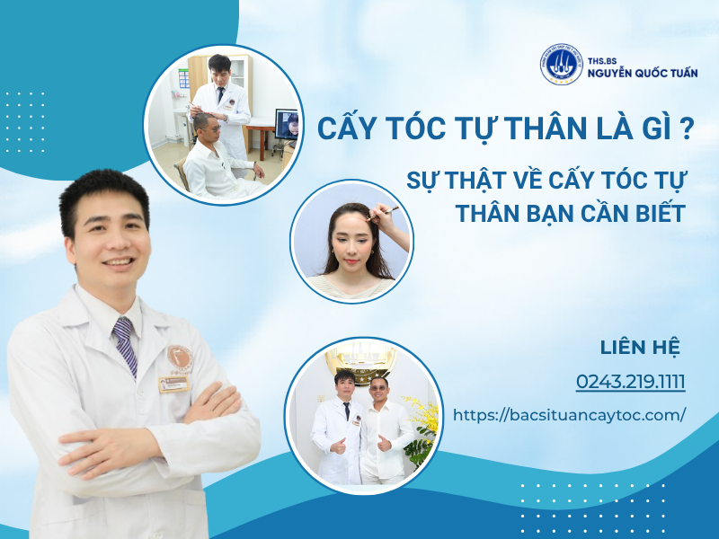 cấy tóc tự thân là gì