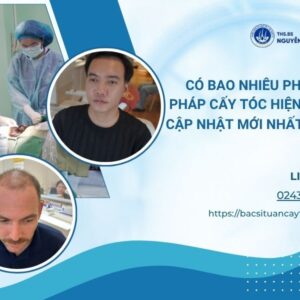 phương pháp cấy tóc