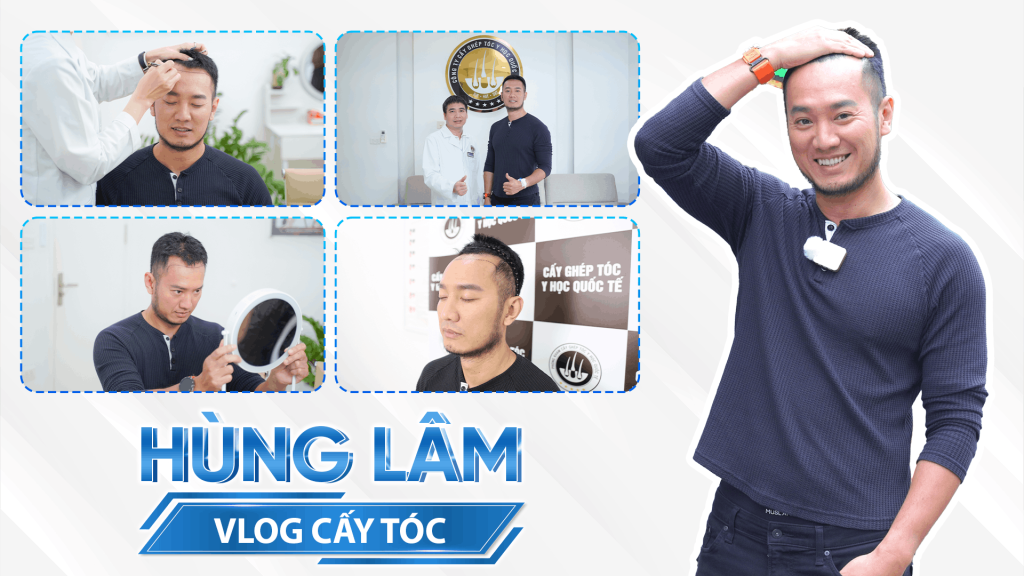 ThS.BS Nguyễn Quốc Tuấn cấy tóc cho Youtuber Hùng Lâm