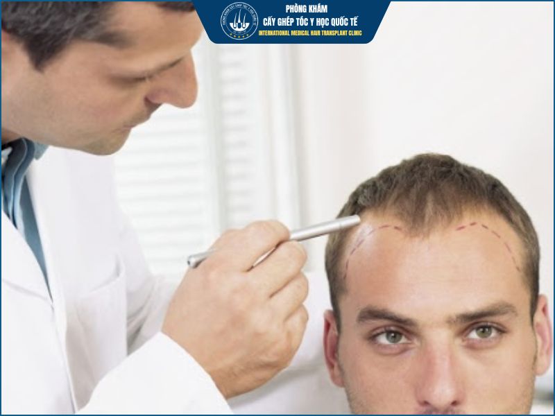 Ai có nguy cơ gặp biến chứng cao hơn khi cấy tóc? 