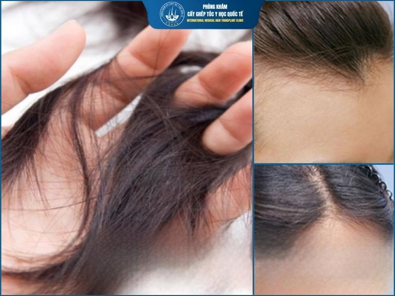 Ai nên chọn phương pháp cấy tóc PNS