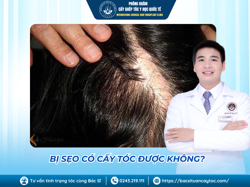 bị sẹo có cấy tóc được không