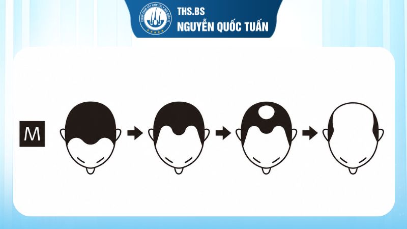 Các cấp độ hói chữ M 
