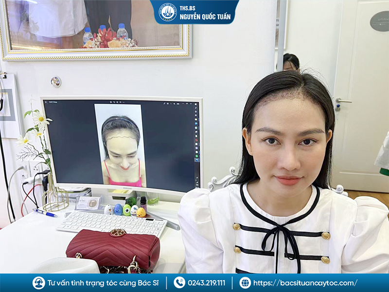 Những ai nên thực hiện điều chỉnh đường chân tóc 
