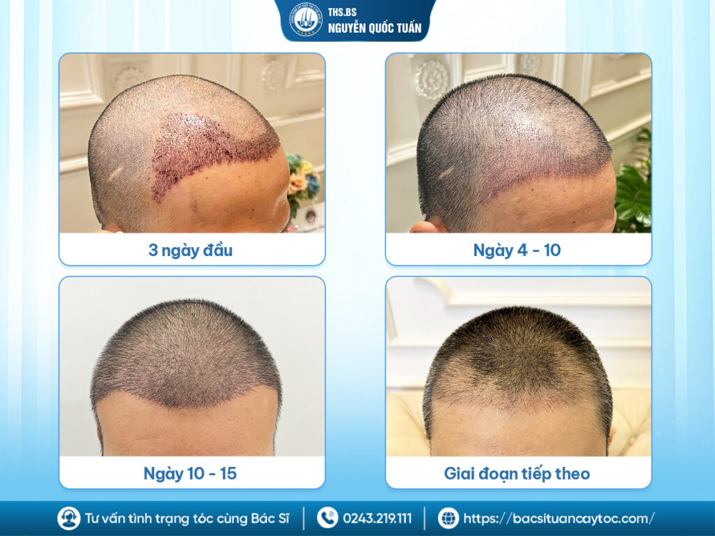 Cách chăm sóc tóc sau cấy theo từng giai đoạn