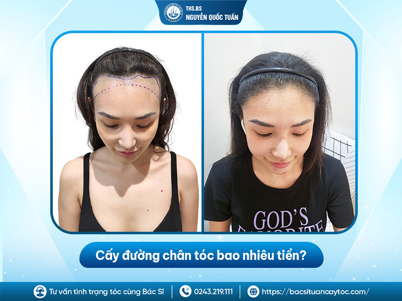 Cấy đường chân tóc bao nhiêu tiền? Cập nhật bảng giá mới nhất 