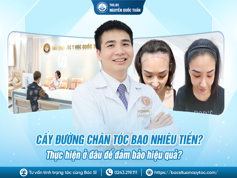 cấy đường chân tóc bao nhiêu tiền