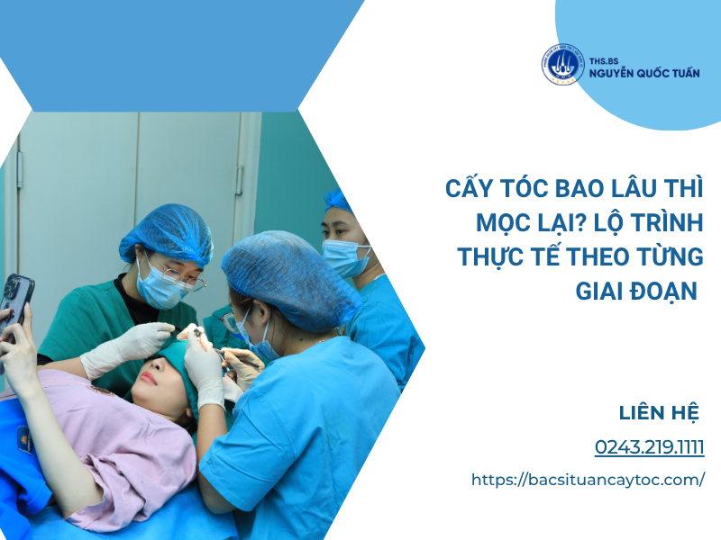 cấy tóc bao lâu mọc lại