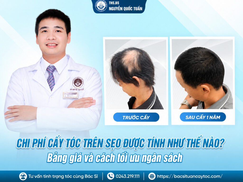 cấy tóc che sẹo giá bao nhiêu