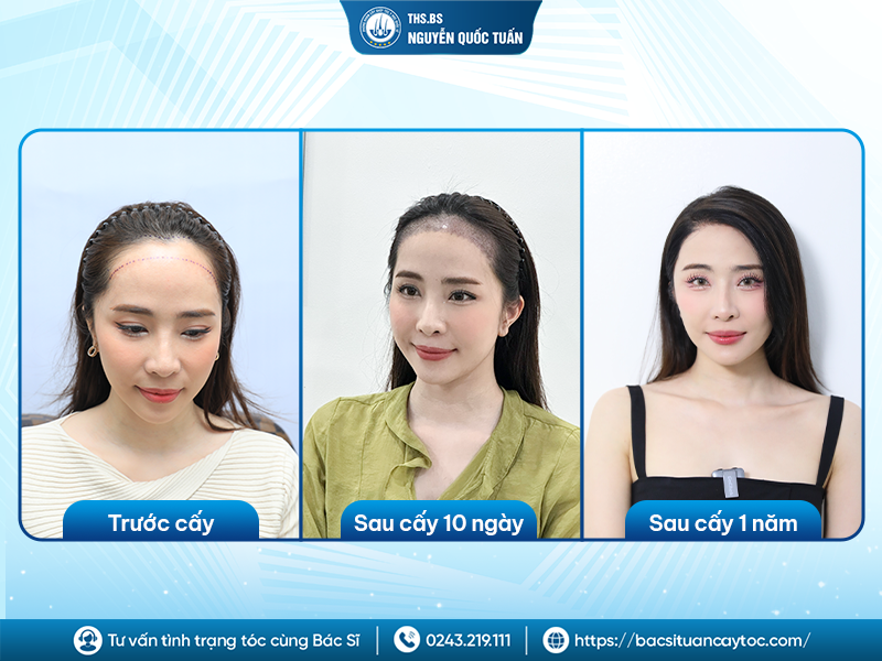 Cấy tóc có để lại sẹo nhìn thấy được không?