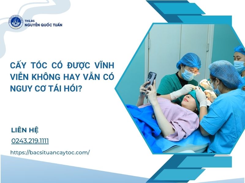 cấy tóc có được vĩnh viễn không