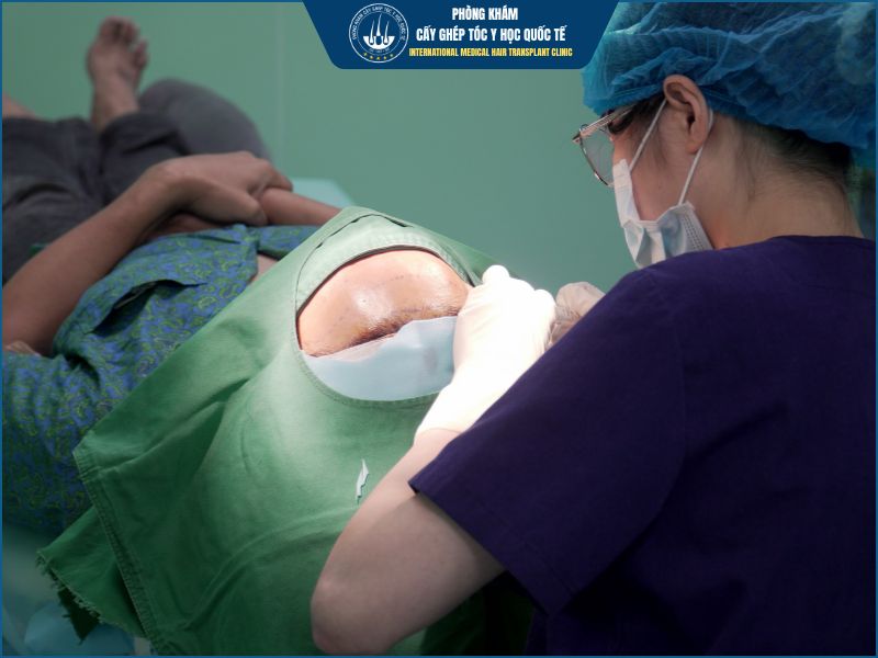 Vì sao cấy tóc tự thân có thể mang lại hiệu quả ổn định? 