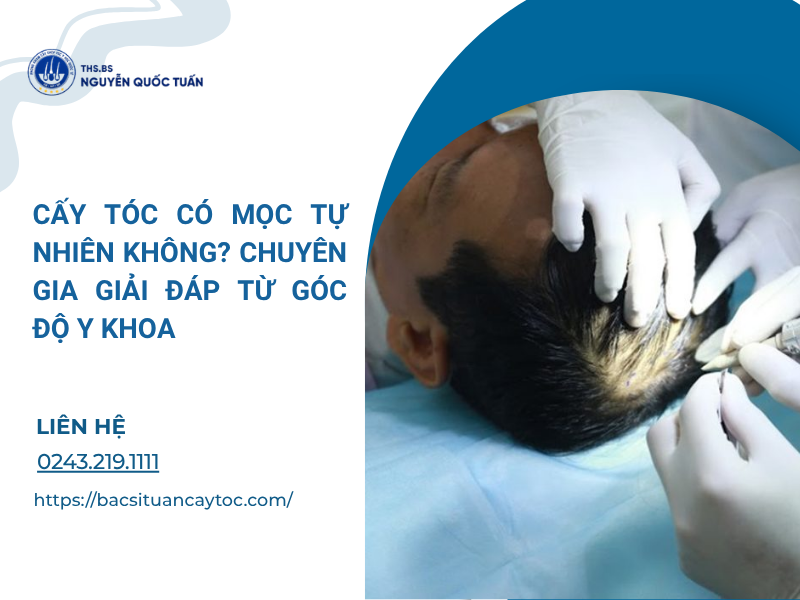 cấy tóc có mọc tự nhiên không