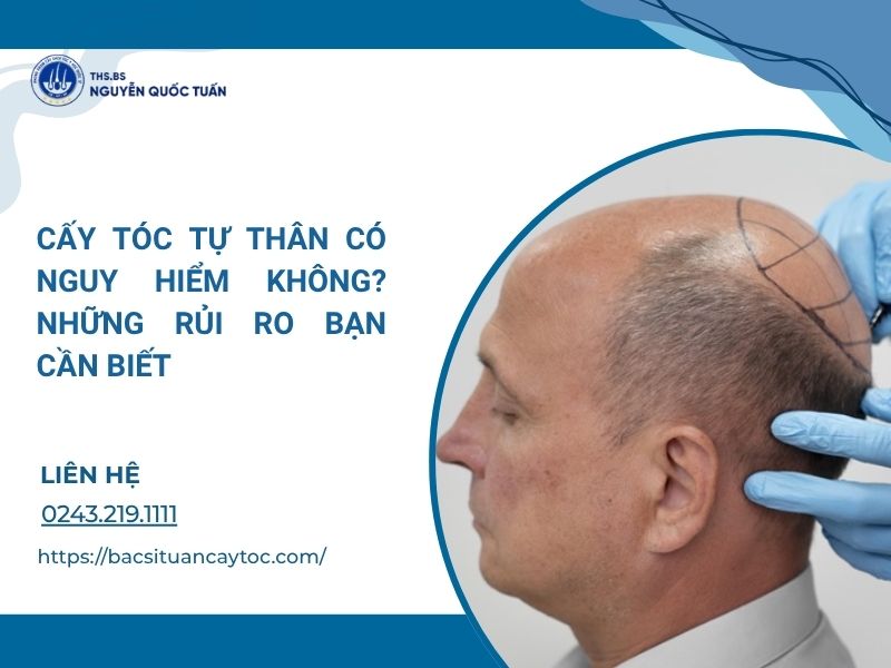 cấy tóc có nguy hiểm không