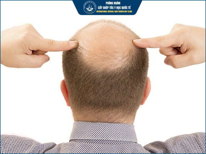 Vì sao vùng hói đỉnh đầu thường khó phục hồi hơn các vị trí khác?