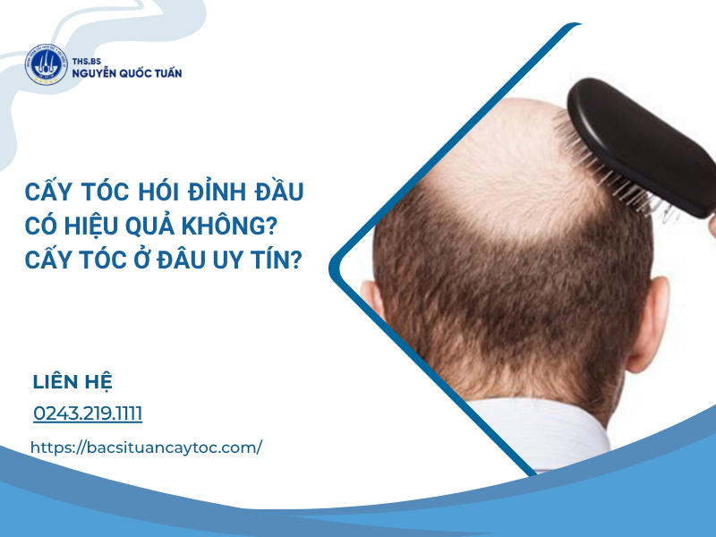 cấy tóc hói đỉnh đầu