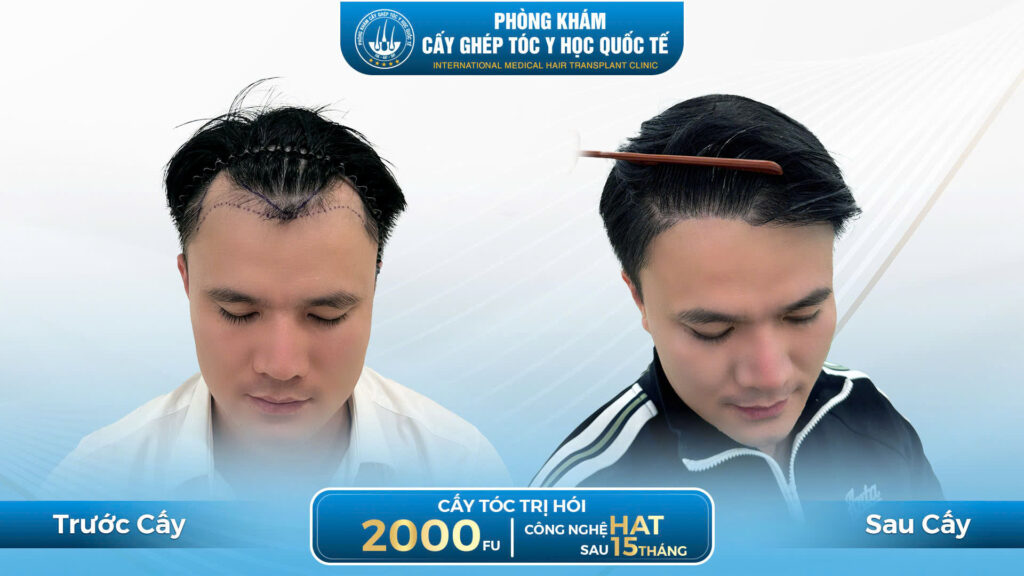 Cấy tóc bao lâu thì đẹp? Thời gian thực tế không phải ai cũng giống nhau