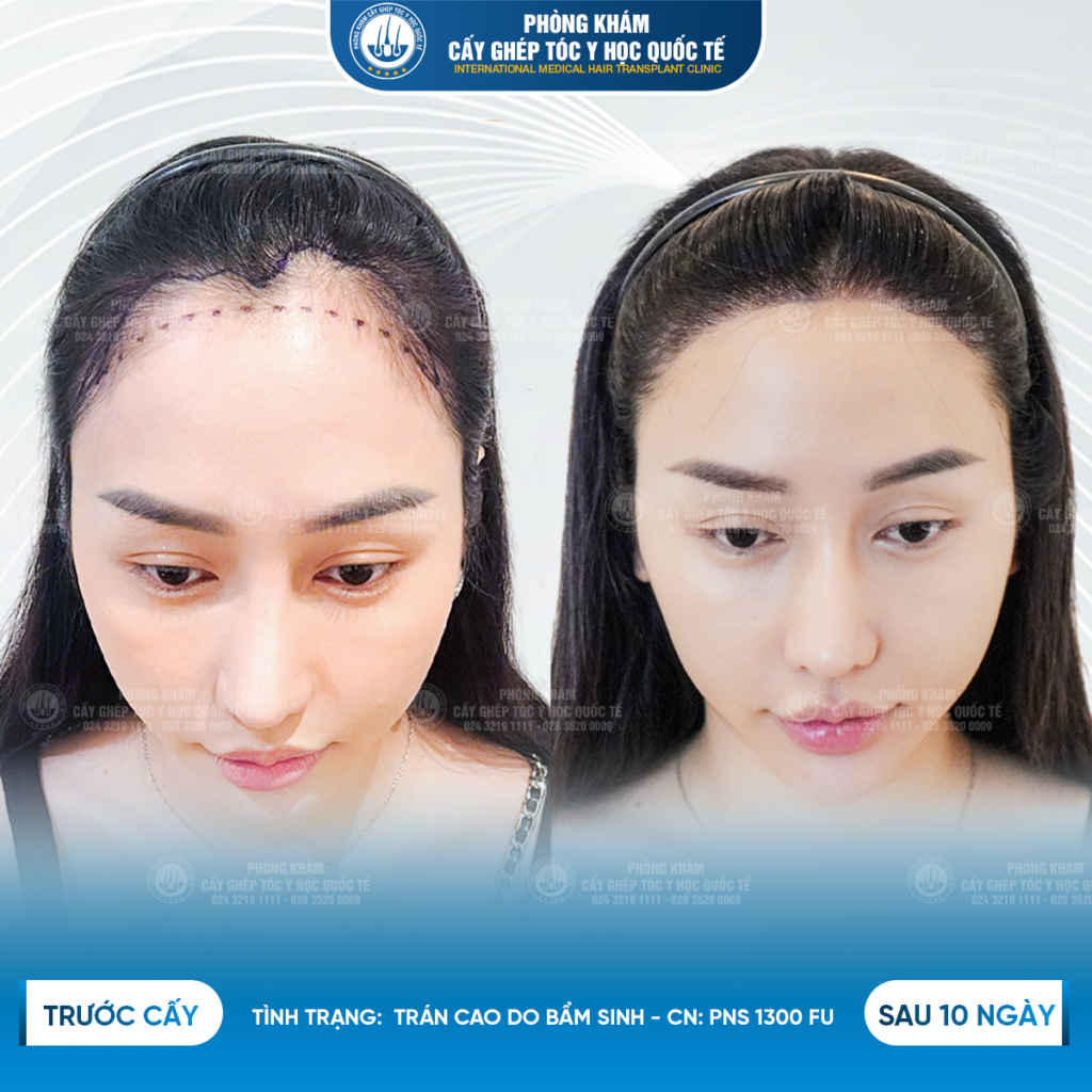 Hiệu quả quá trình cấy tóc PNS