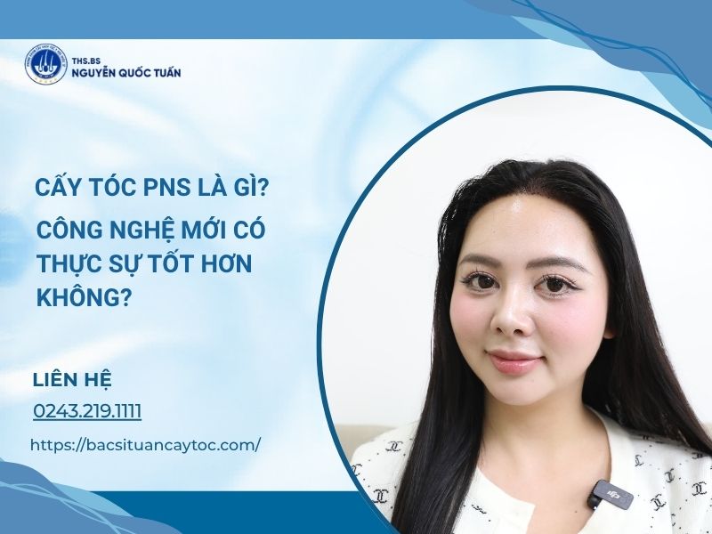 cấy tóc pns
