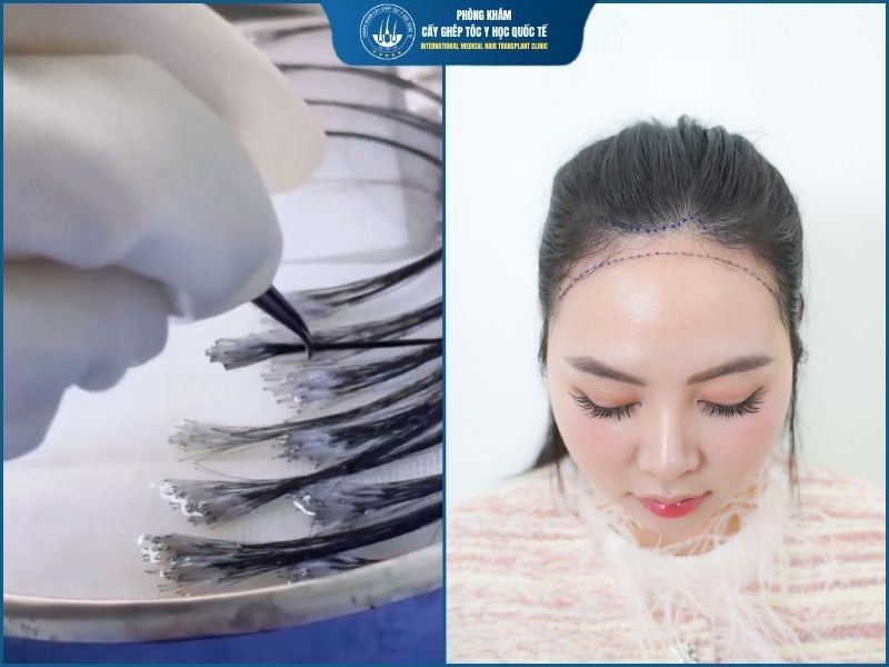 Cấy tóc PNS là gì