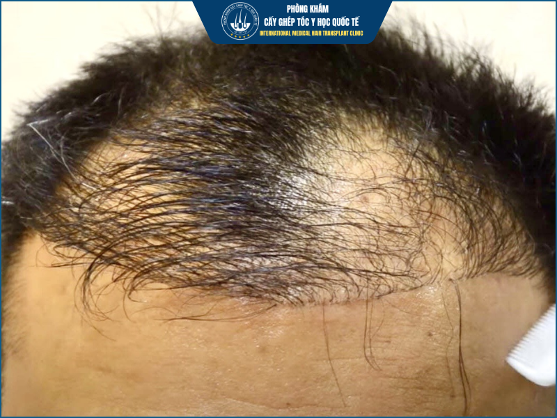 Khi nào được xem là cấy tóc thất bại?