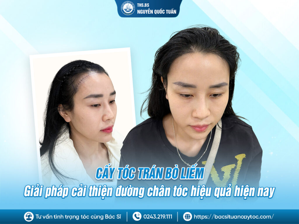 cấy tóc trán bò liếm