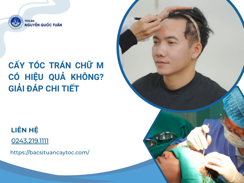 cấy tóc trán chữ m có hiệu quả không