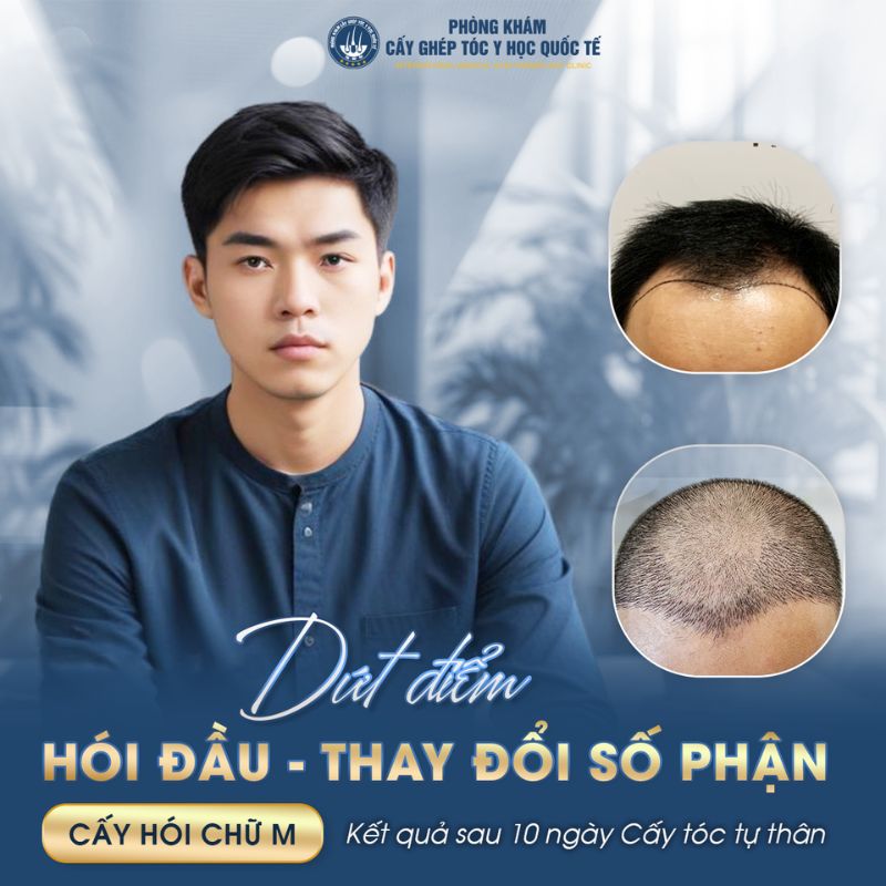 Những yếu tố ảnh hưởng tới kết quả cấy tóc