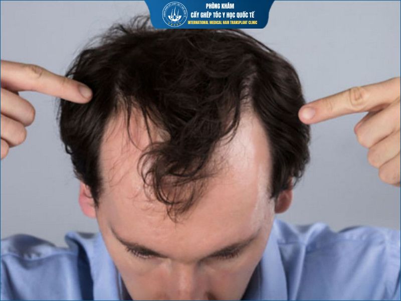 Trán chữ M hình thành do đâu?