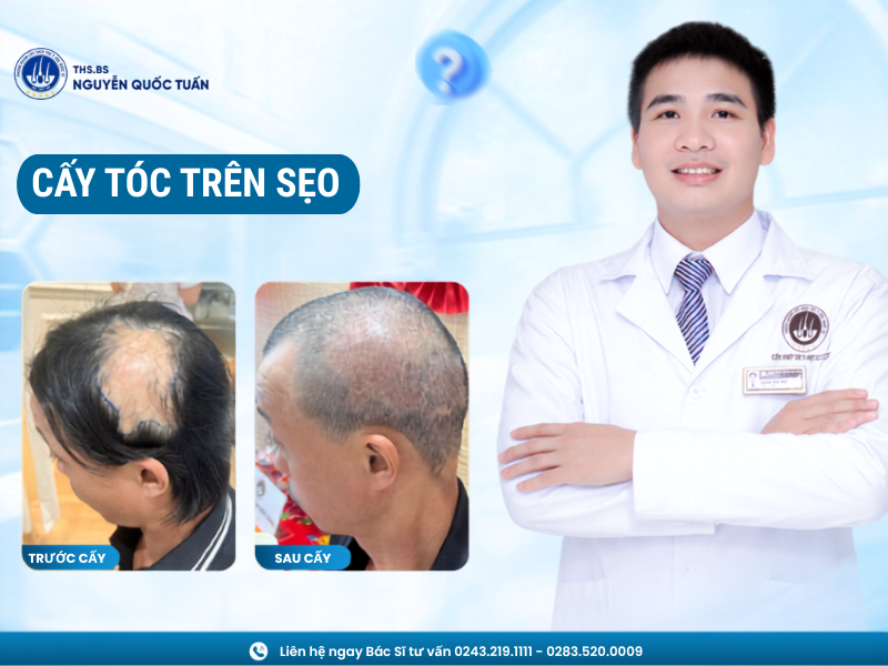 cấy tóc trên sẹo
