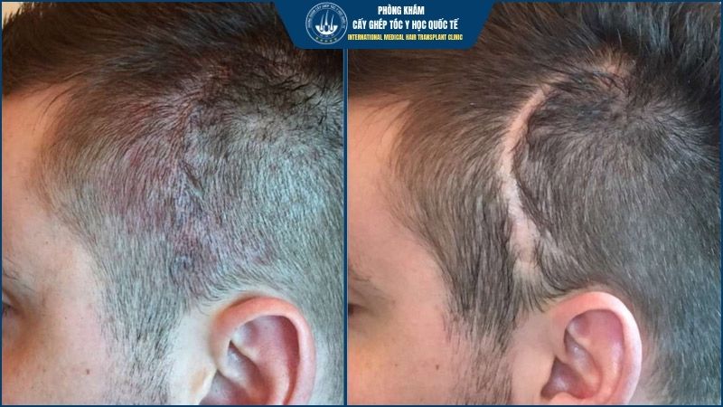 Cấy tóc bị sẹo có đau không và có an toàn không? 