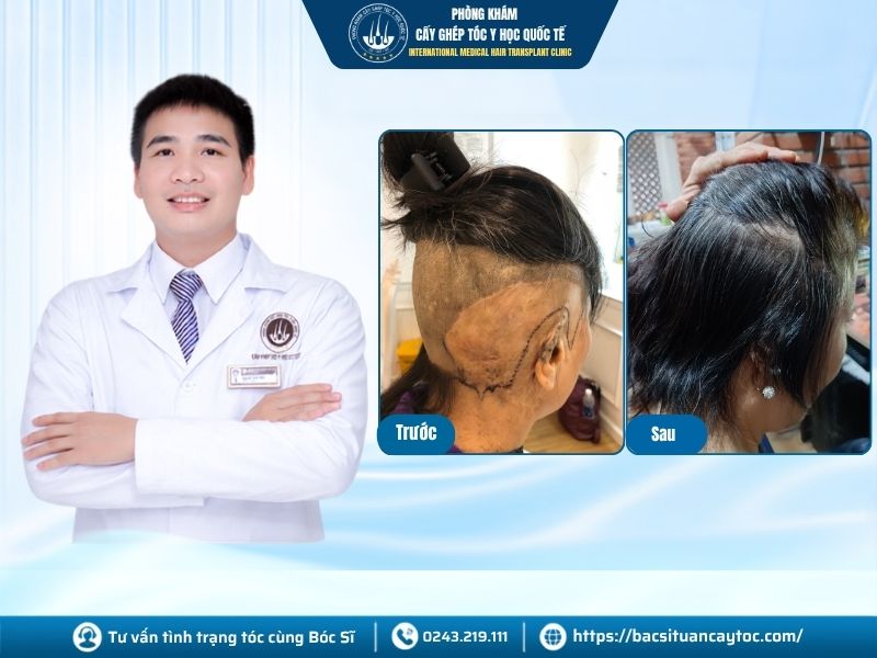 Cấy tóc bị sẹo có hiệu quả không? 