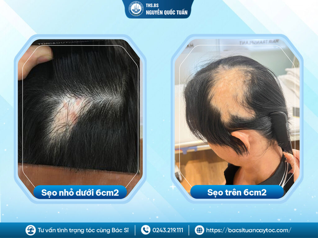  Cấy tóc trên sẹo giá bao nhiêu? Cập nhật bảng giá mới nhất 