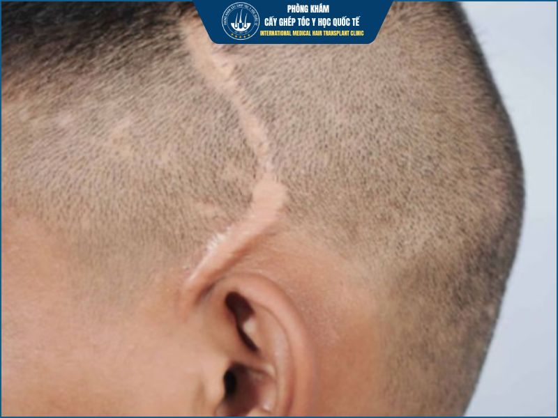 Cấy tóc trên sẹo là gì? 