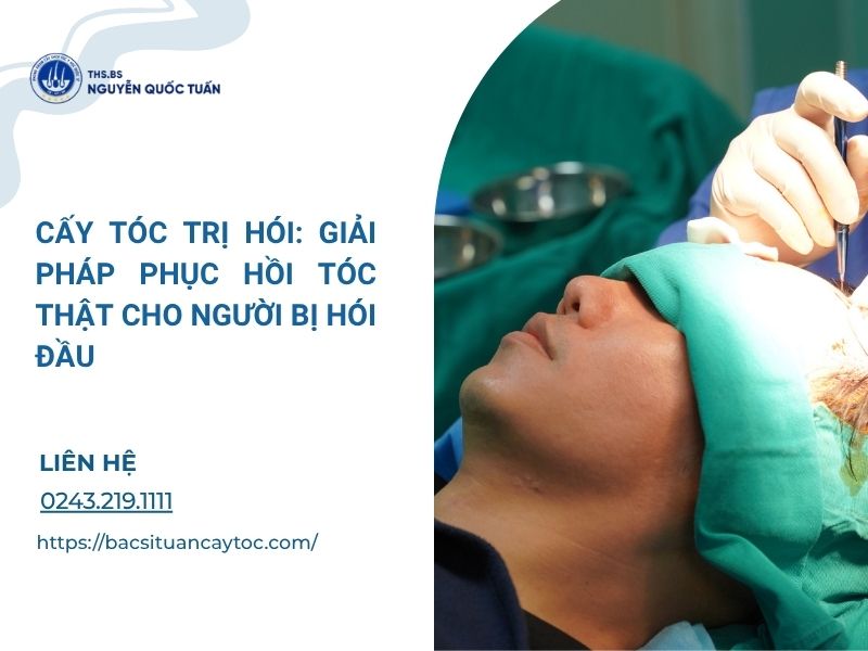 cấy tóc trị hói
