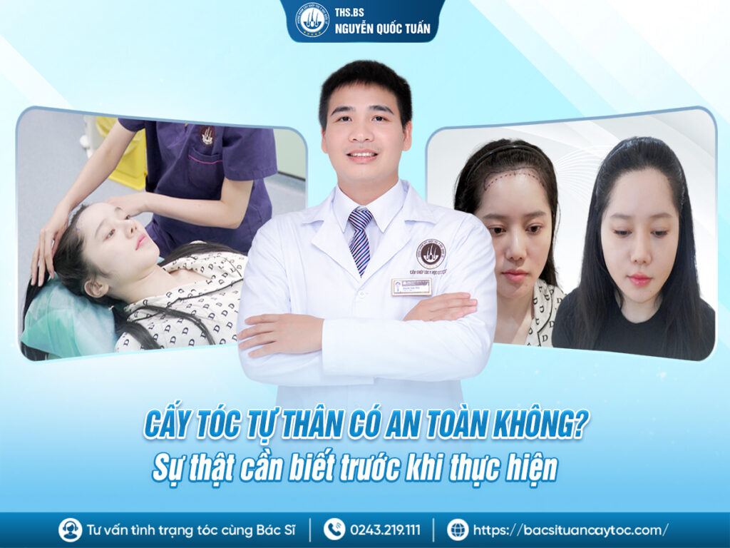 cấy tóc tự thân có an toàn không