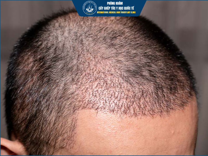Cấy tóc tự thân có nguy hiểm không?  