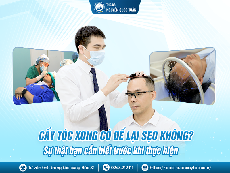 cấy tóc xong có để lại sẹo không