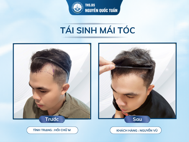 Cấy tóc chữa hói có bị rụng lại không? 