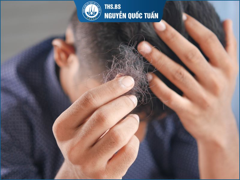 Dấu hiệu nhận biết hói chữ M nam  