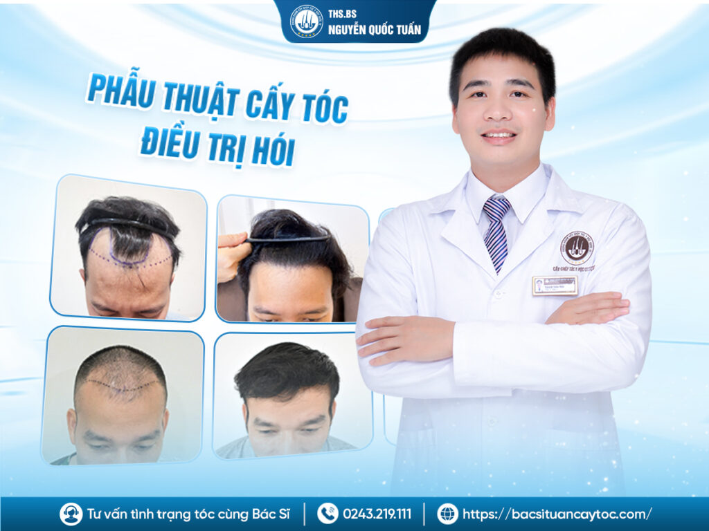 điều trị hói tóc