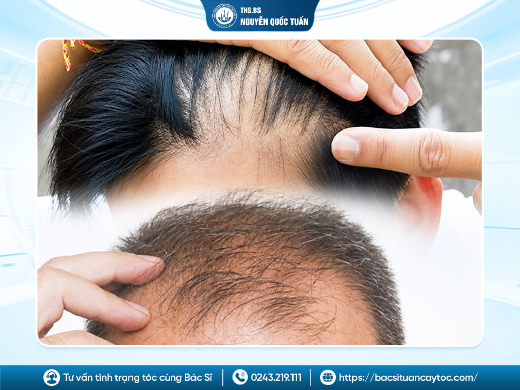 Những trường hợp nên và không nên phẫu thuật cấy tóc
