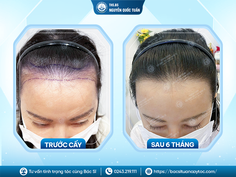 Giá thành có phải là yếu tố quan trọng khi cấy hạ chân tóc? 