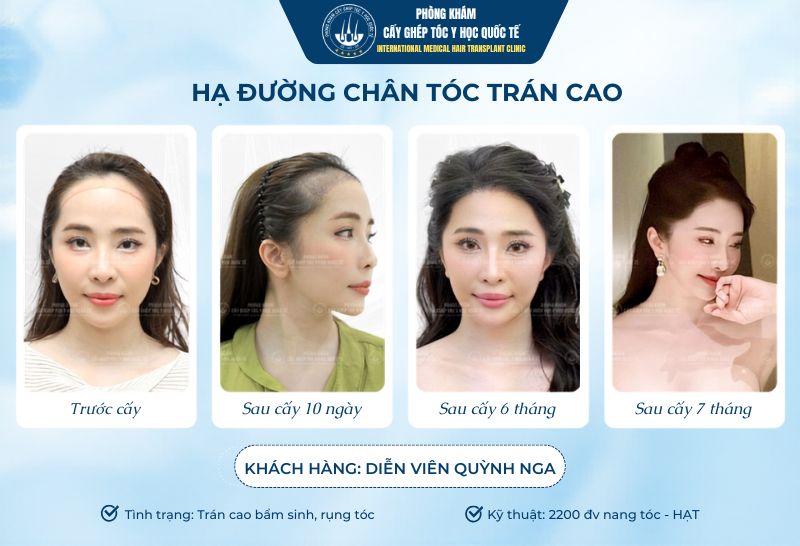 Cấy đường chân tóc có duy trì vĩnh viễn không?