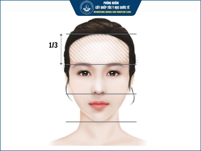 Vì sao trán cao nhưng mỗi người lại cần phương pháp khác nhau?